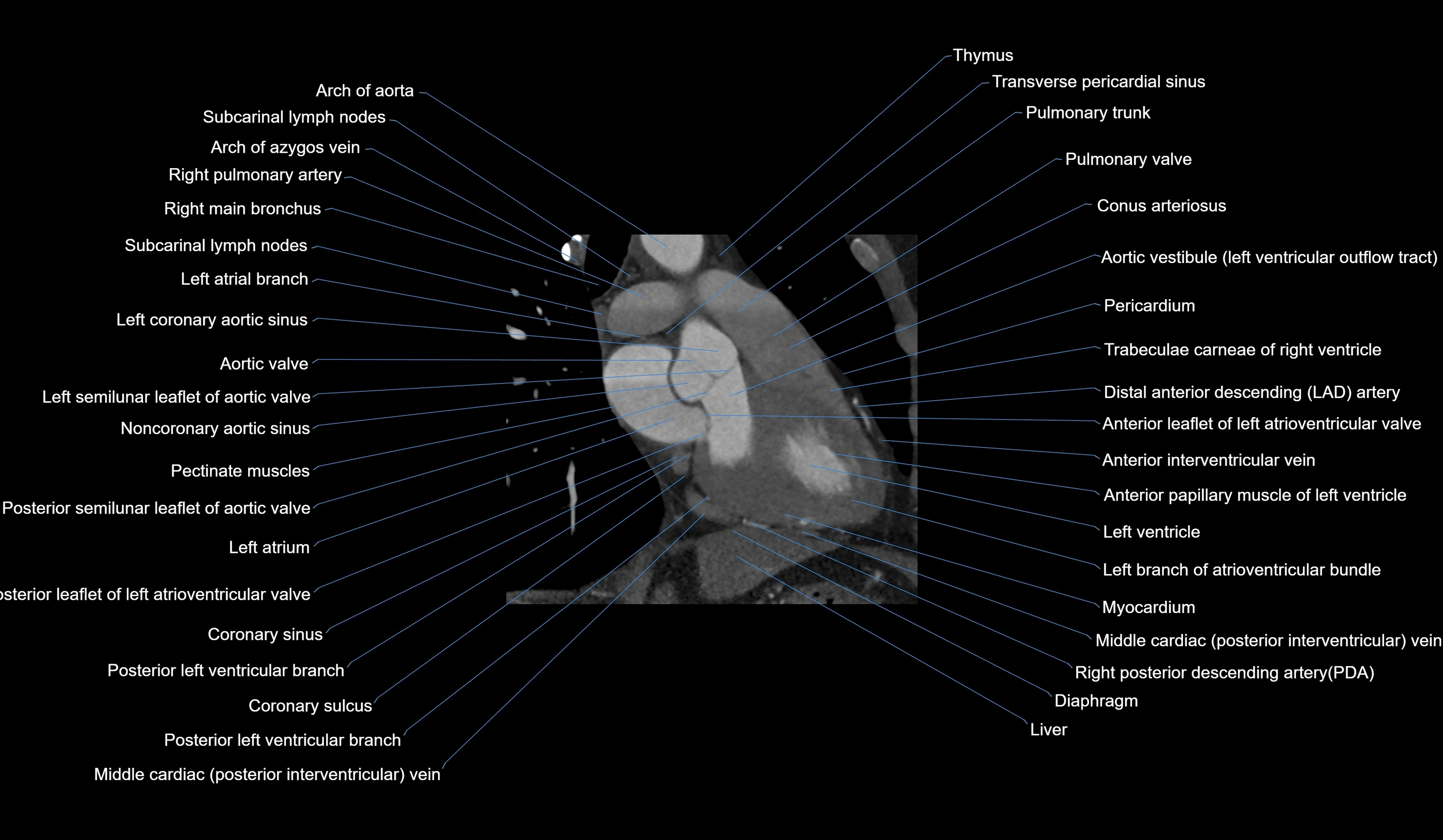 CT heart (coronary angiogram) 2 chamber view cross sectional anatomy labelled radiology image-00021.webp